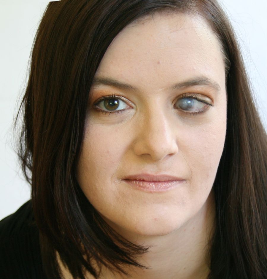 So hier ein Foto falls Interesse besteht. Das bin ich und so sehe ich aus als Erwachsene der als kleines Kind eine Linse eingepflanzt wurde ins Auge mit einem Jahr.